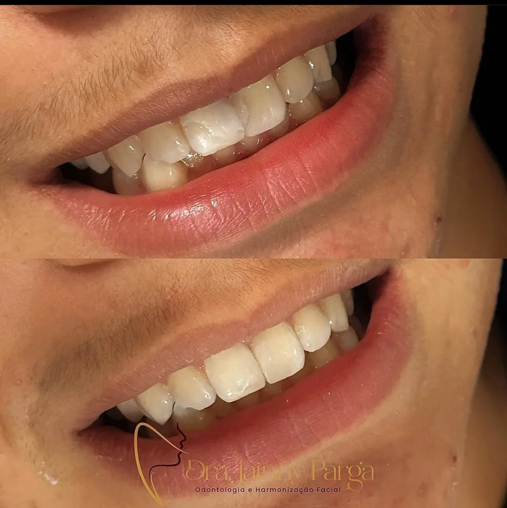 Sorriso antes e depois do tratamento estético