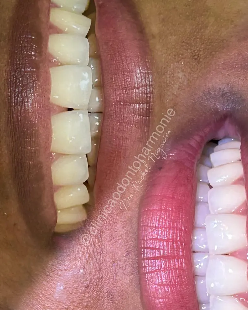 Sorriso depois do clareamento dental de consultório
