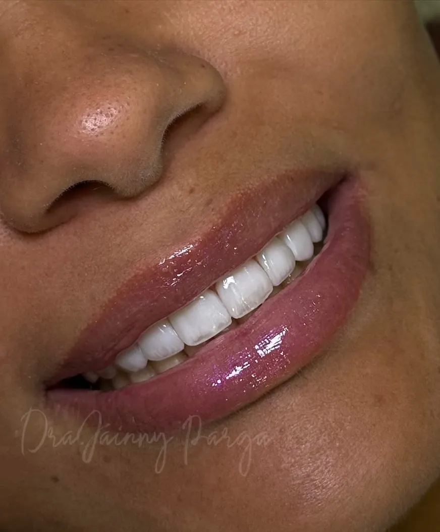 Sorriso depois do fechamento do diastema entre os dentes da frente